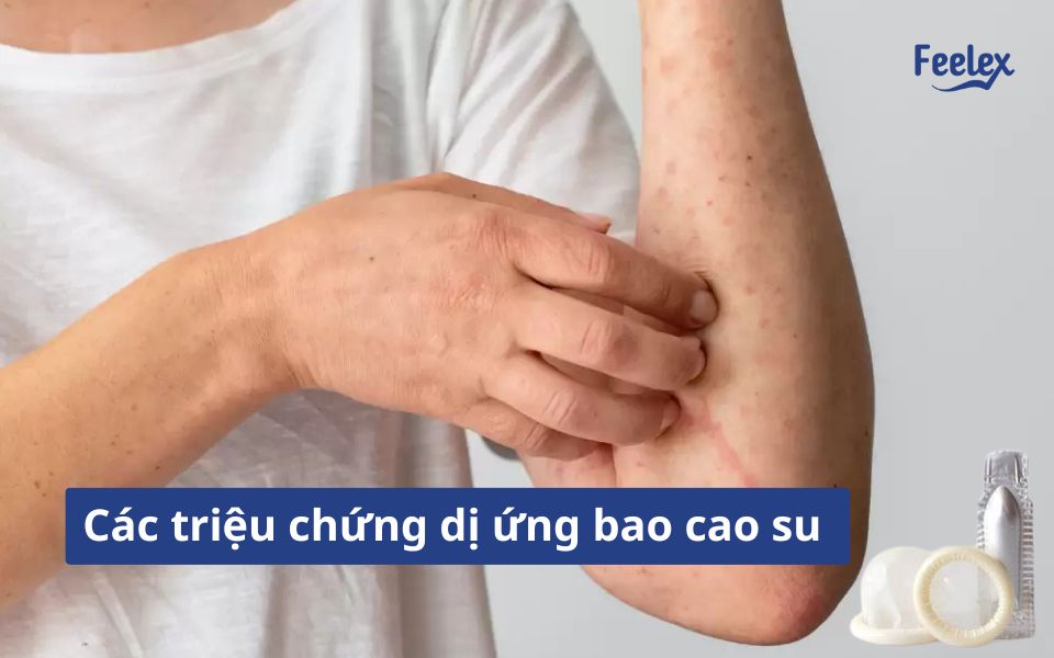 Các triệu chứng dị ứng bao cao su