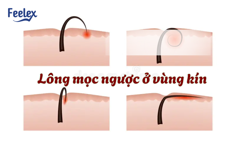 Lông mọc ngược ở vùng kín