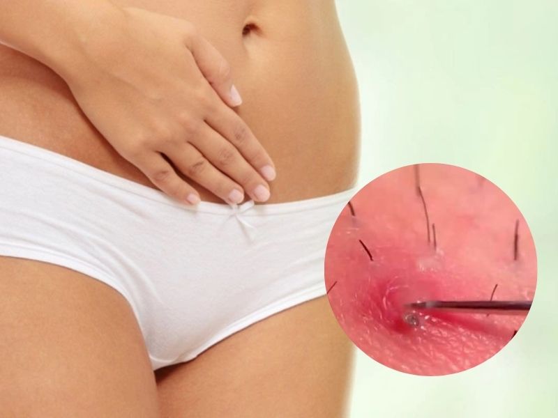 Viêm nang lông vùng kín nam - 5 mẹo khắc phục siêu nhanh Tìm hiểu về viêm nang lông vùng kín nam