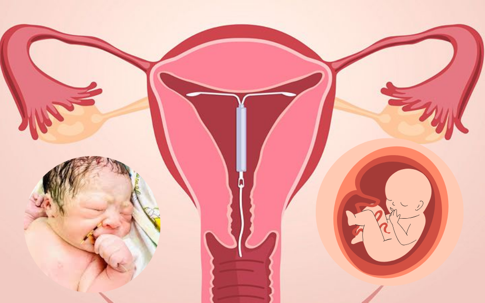 Đặt vòng tránh thai vẫn có thai