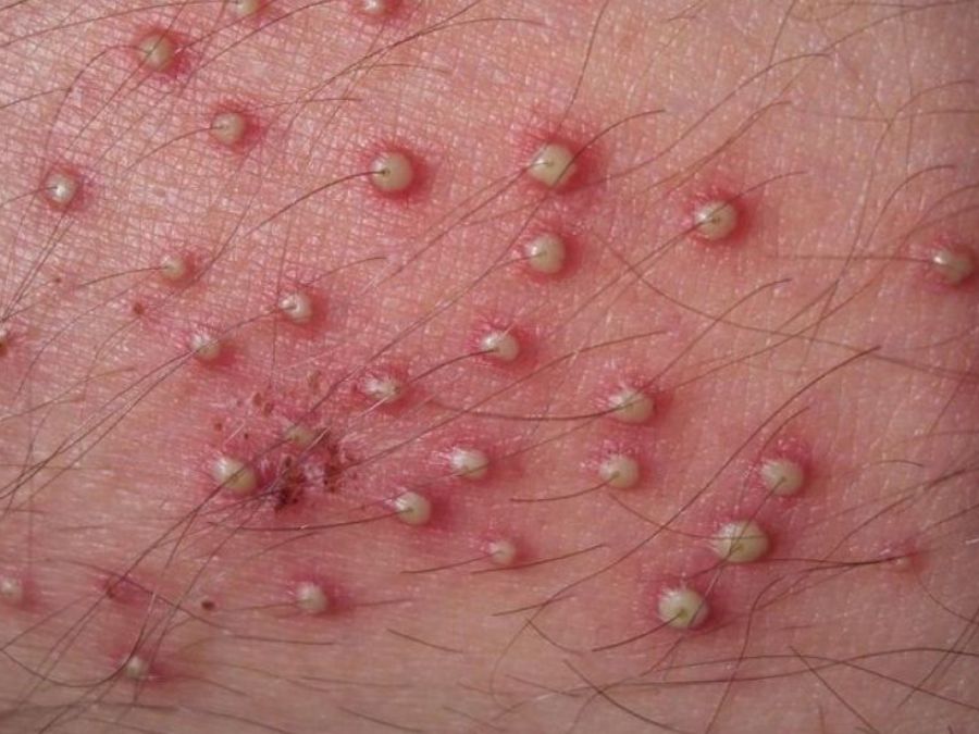 Các loại mụn ở bộ phận sinh dục nam: 4 cách xử lý an toàn nhất Mun o vung kin