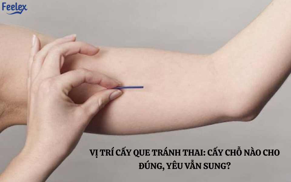 Vị trí cấy que tránh thai