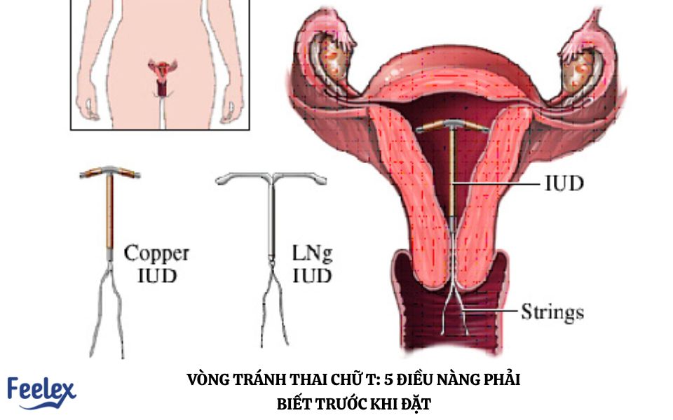 Vòng tránh thai chữ T