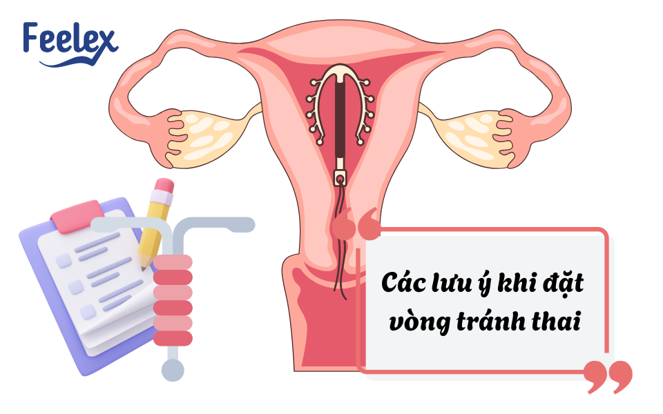 Các lưu ý khi đặt vòng tránh thai