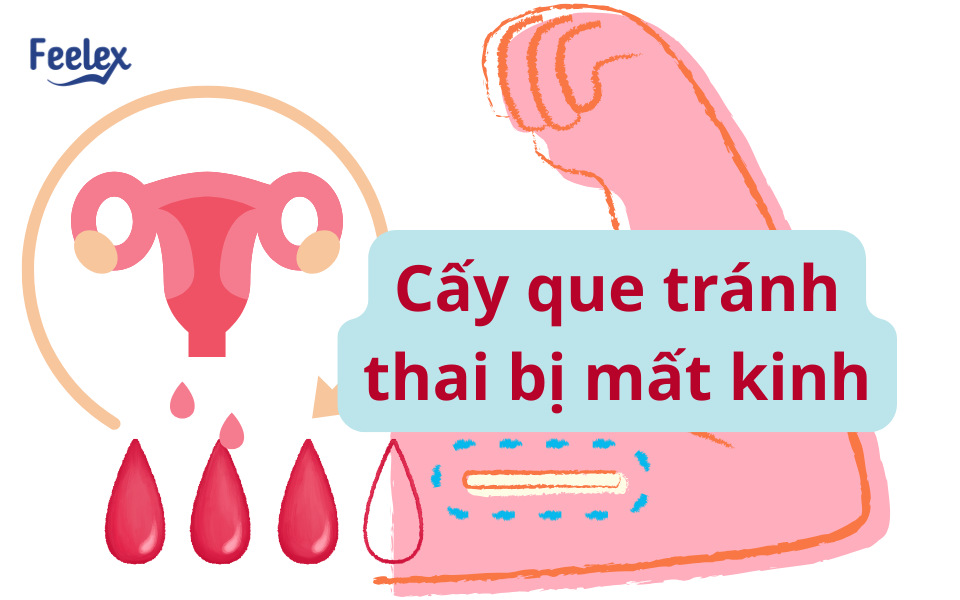 Cấy que tránh thai bị mất kinh