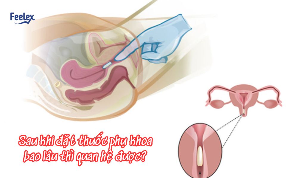 sau khi đặt thuốc phụ khoa bao lâu thì quan hệ được