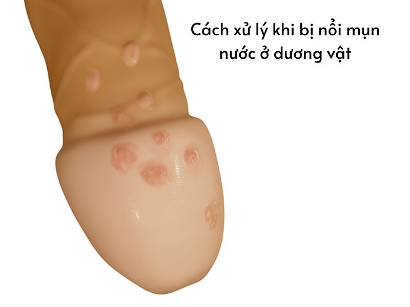 Nổi mụn nước ở dương vật: 7 Nguyên nhân, 5 Cách xử lý Cách xử lý khi bị nổi mụn nước ở dương vật