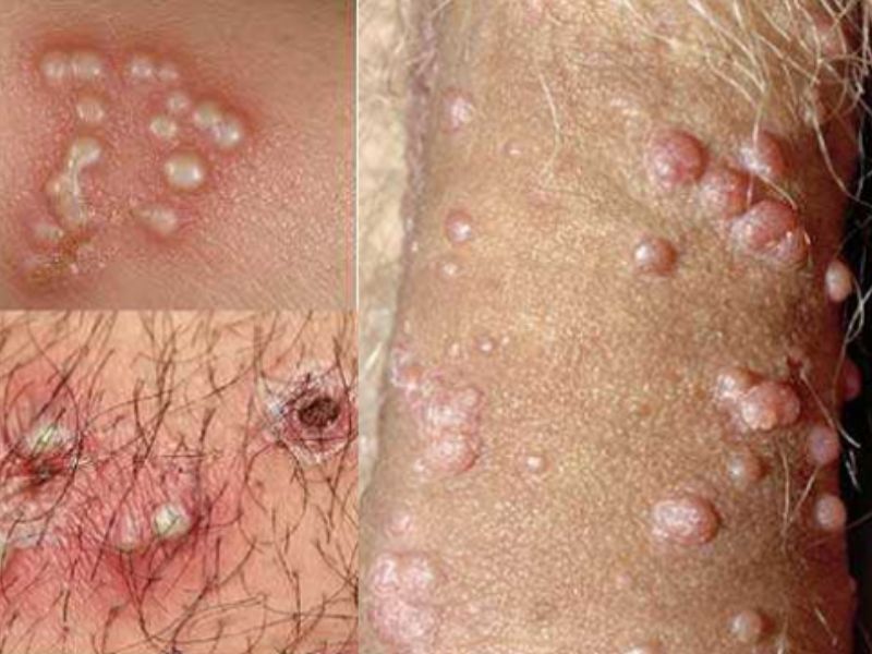 Mụn Rộp Dương Vật: 7 Dấu Hiệu Không Thể Bỏ Qua bị mụn rộp ở dương vật