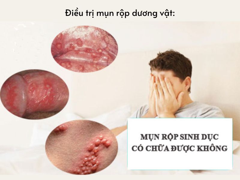 Mụn Rộp Dương Vật: 7 Dấu Hiệu Không Thể Bỏ Qua mụn rộp ở bao quy đầu