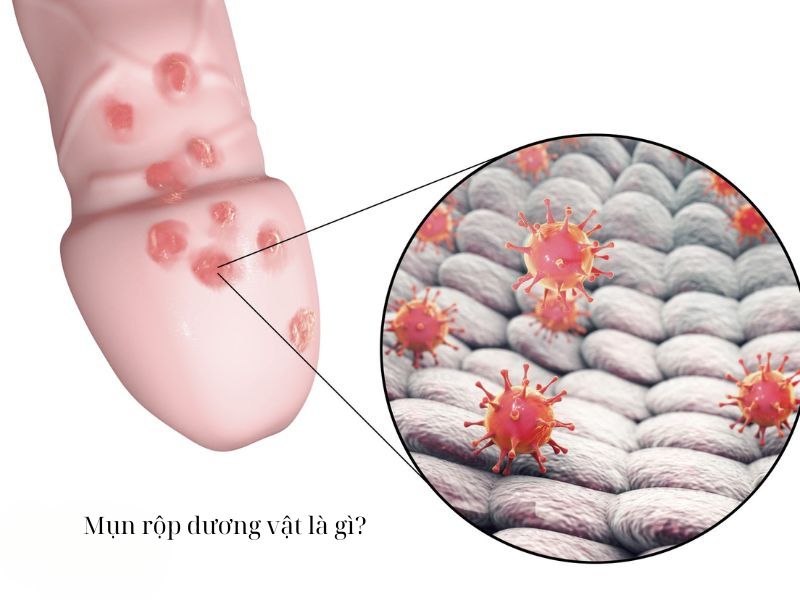 Mụn Rộp Dương Vật: 7 Dấu Hiệu Không Thể Bỏ Qua Mụn rộp dương vật