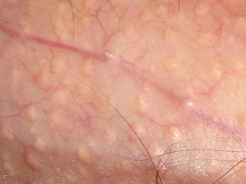 Nổi mụn nước ở dương vật: 7 Nguyên nhân, 5 Cách xử lý nổi mụn nước ở dương vật
