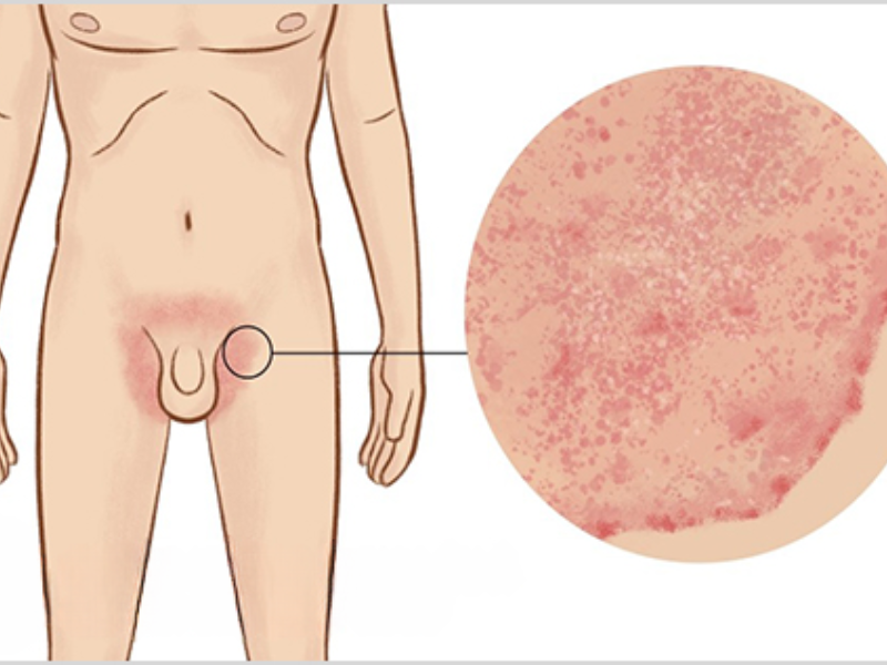 8 Cách Xử Lý Viêm Da Vùng Kín Nam Được Bác Sĩ Khuyên Dùng Viêm Da Vùng Kín Nam