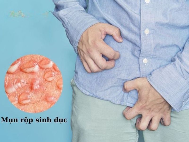 Mụn Rộp Dương Vật: 7 Dấu Hiệu Không Thể Bỏ Qua mụn rộp ở vùng kín nam