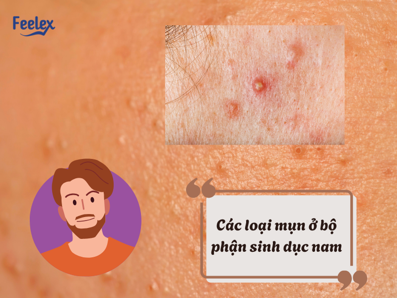Các loại mụn ở bộ phận sinh dục nam