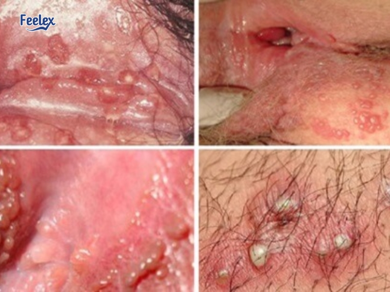 Cách xử lý khi bị nổi đốm trắng ở vùng kín nam