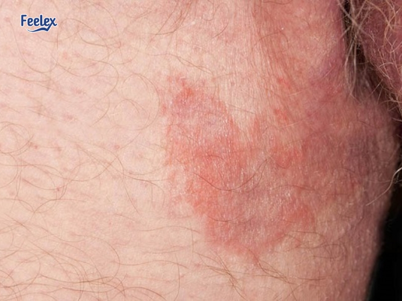Dị ứng hoặc kích ứng da