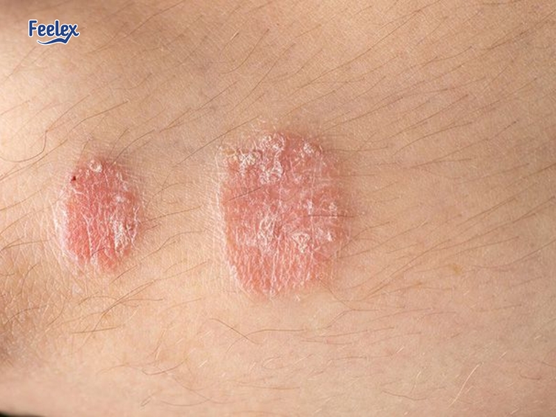 7 Nguyên Nhân & Cách Xử Lý Khi Nổi Mụn Ở Vùng Kín Nam Giới Dị ứng hoặc kích ứng da