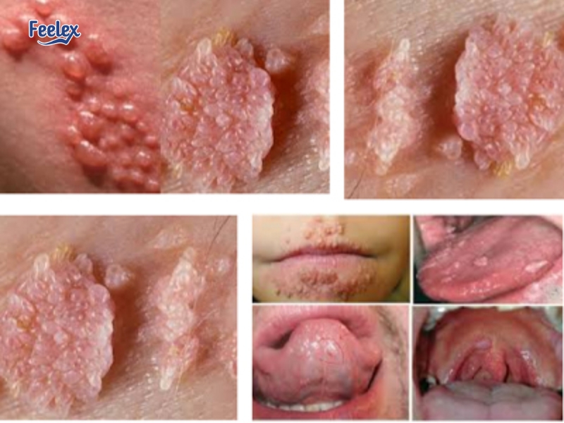 Mắc bệnh lây truyền qua đường tình dục (STDs)