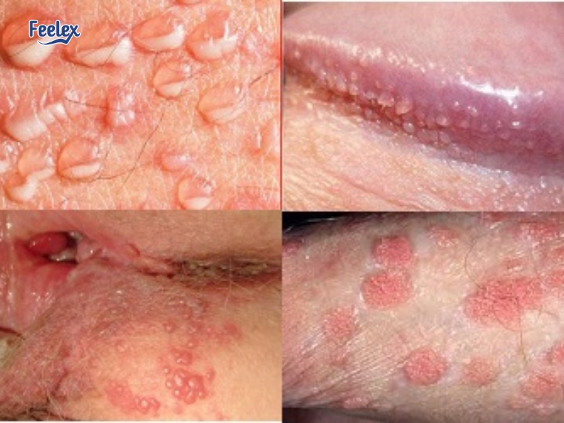 7 Nguyên Nhân & Cách Xử Lý Khi Nổi Mụn Ở Vùng Kín Nam Giới Mắc bệnh lây truyền qua đường tình dục (STDs)