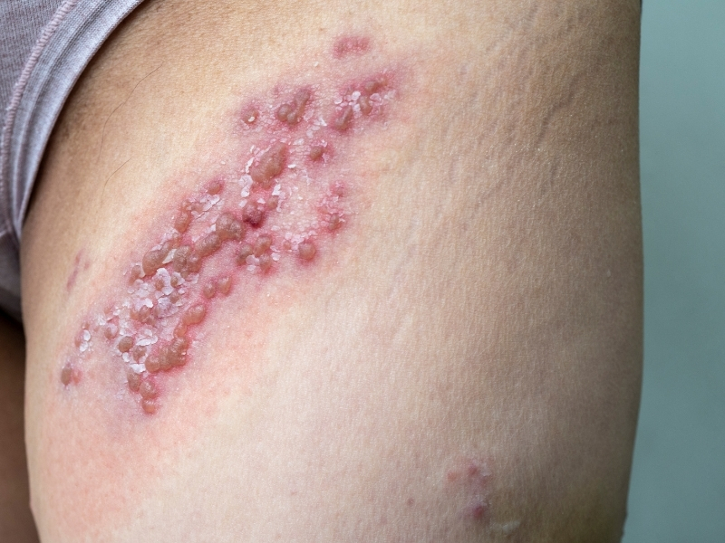 Các loại mụn ở bộ phận sinh dục nam: 4 cách xử lý an toàn nhất Mụn rộp sinh dục (Herpes)