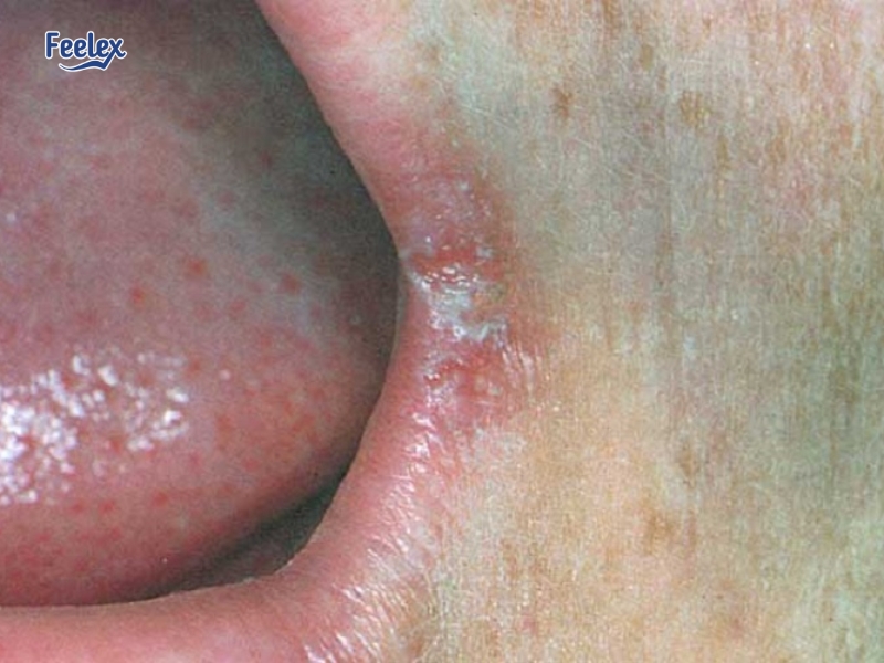 7 Nguyên Nhân & Cách Xử Lý Khi Nổi Mụn Ở Vùng Kín Nam Giới Nhiễm nấm hoặc vi khuẩn