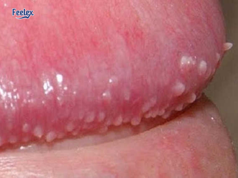 Nổi đốm trắng ở vùng kín là gì?