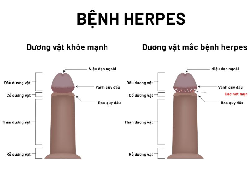 Nổi mụn nước ở dương vật: 7 Nguyên nhân, 5 Cách xử lý mọc mụn nước ở bộ phận sinh dục nam