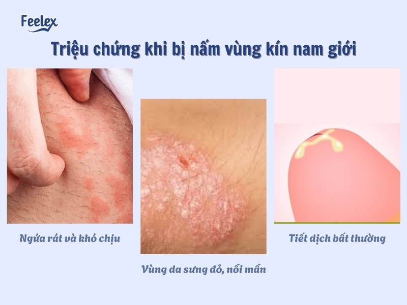 7 Thông Tin Quan Trọng Về Nấm Vùng Kín Nam Giới – Nguyên Nhân, Triệu Chứng & Cách Điều Trị Triệu chứng khi bị nấm vùng kín nam giới